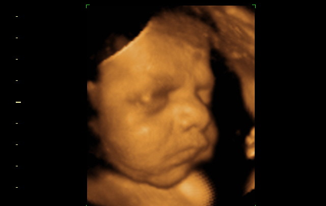 Aborton Activists Claim an Unborn Baby is Merely a ‘Gestator’s’ Body Part