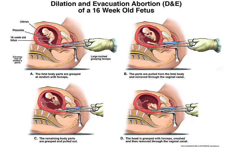 New Senate Bill Would Ban Killing Babies in Dismemberment Abortions