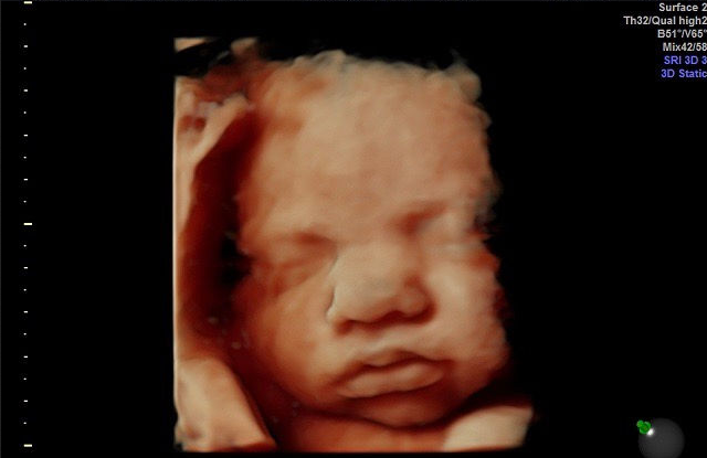 IVF Kills More Unborn Babies Than Planned Parenthood