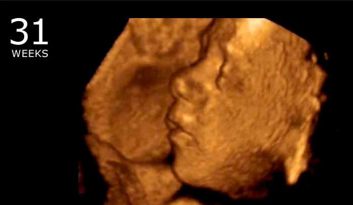 States With Unlimited Abortions Kill So Many Babies They’re Below Replacement Rate